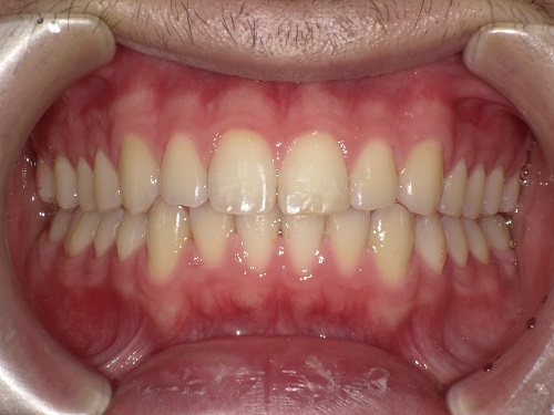 前歯の矯正症例after